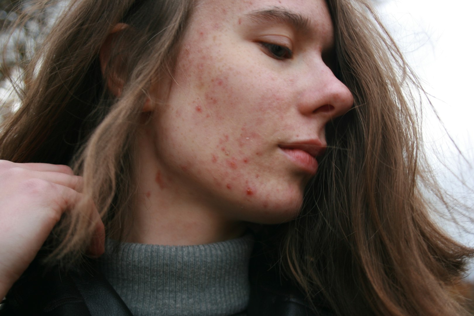 Dermal Filler