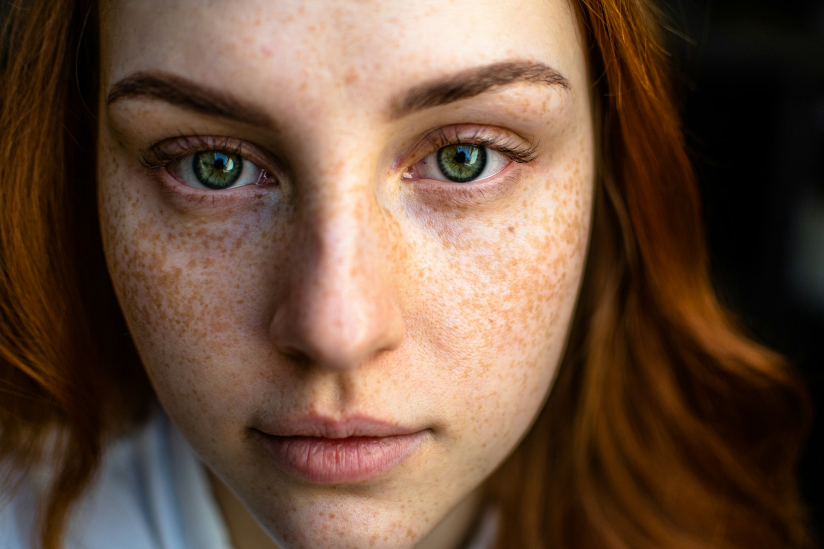 Dermal Filler in Scone